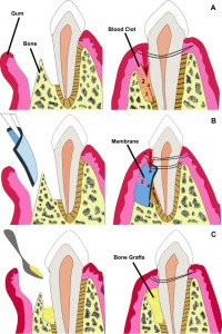 Prisma Dental Periodontal Regenerative Surgery