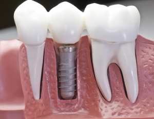 costa rica dental implants