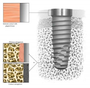 costa rica dental implants