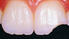 broken chipped tooth