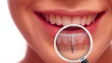 costa rica dental implants 1