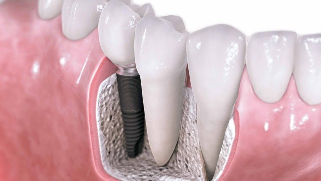 dental implants costa rica 1