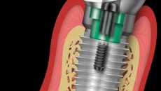 dental implants costa rica 2