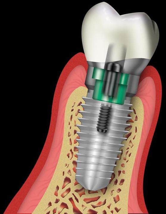 dental implants costa rica 2