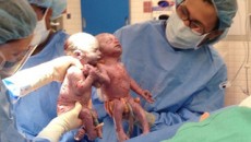 twins born holding hands