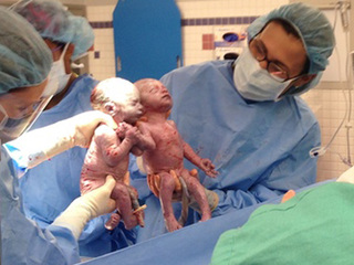 twins born holding hands