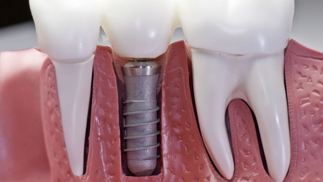 dental implants costa rica