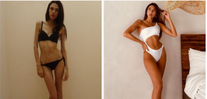 Valeria Rees anorexia