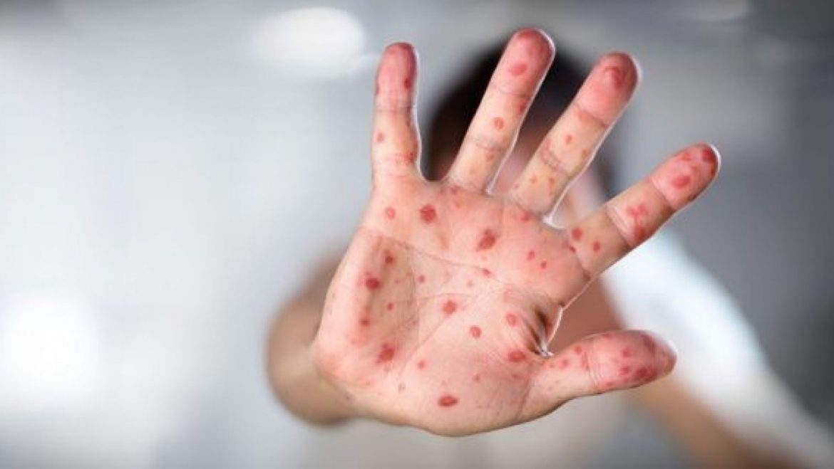 French Family Brings the Measles to Costa Rica