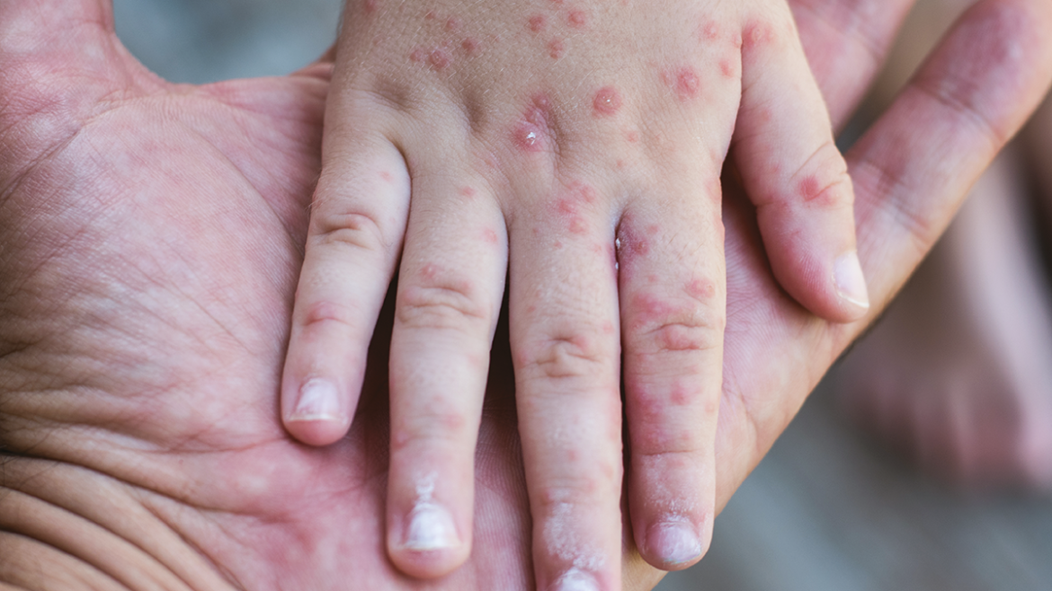 Measles Makes a Comeback in Costa Rica: A Health Challenge Amidst a Vaccinated Population