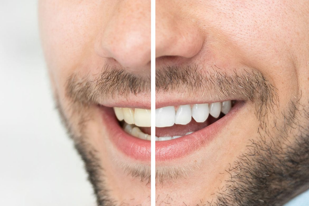 Bright Smiles in the Balance: Costa Rica’s Dramatic Shift in Teeth Whitening Regulations!